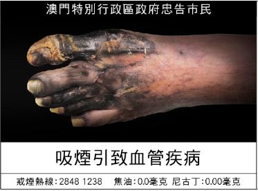 Macau 2013 Health Effect vascular system - gangrene, diseased foot, gross (Chinese)
